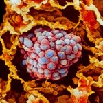 celulas-cancer-globulos