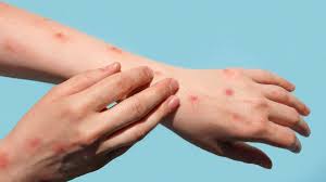 Campeche Investiga Dos Casos Sospechosos de Viruela Símica