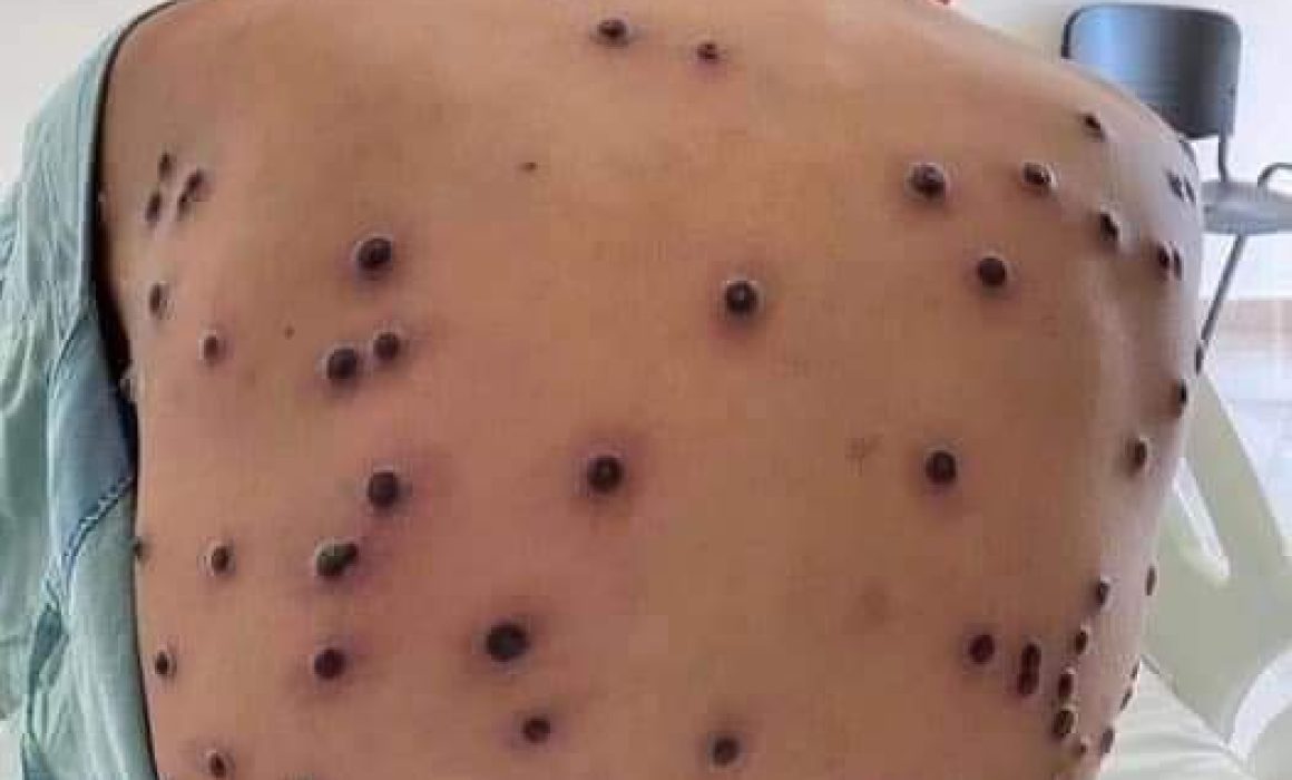 Confirman un caso positivo de viruela del mono en Tlaxcala
