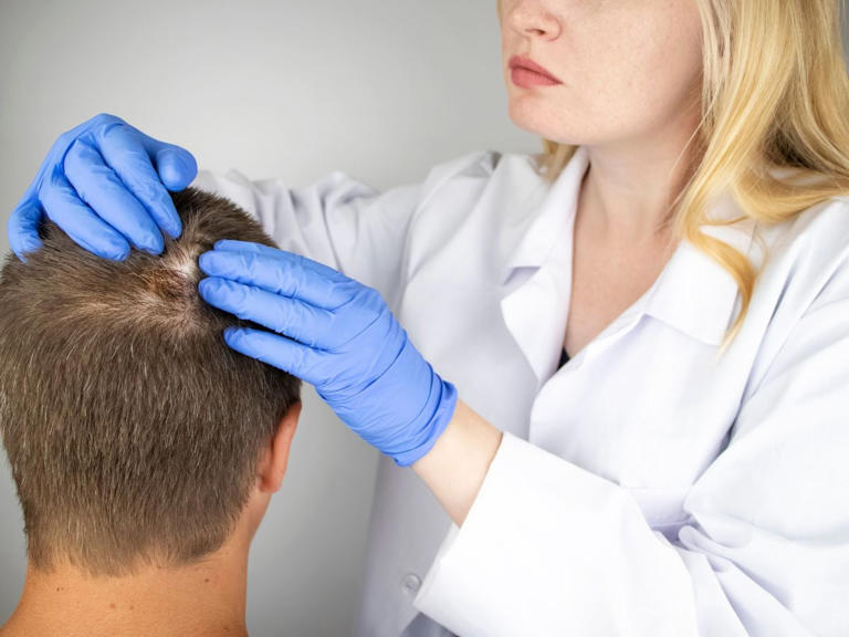Alopecia: señales y lo que puedes hacer para frenar la caída del cabello