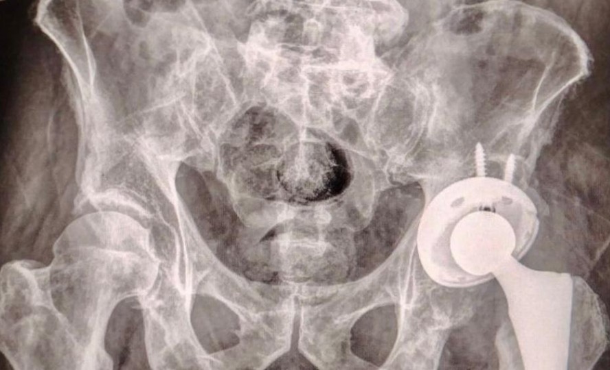 Primera prótesis de cadera gratuita en el ISSSTEP: un avance en salud pública