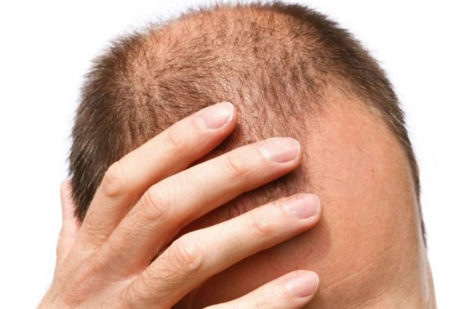 ¿Cuándo es preocupante la caída del cabello en los hombres?