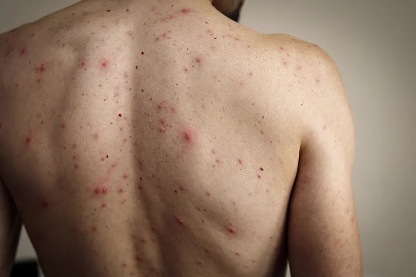 Vuelve uso de cubrebocas y gel antibacterial en Tlaxcala; se confirma brote de Sarampión