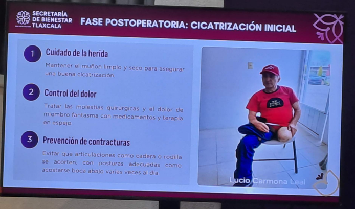 Persona con prótesis durante rehabilitación