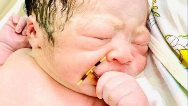 La vida siempre encuentra la forma: Bebé nace con el DIU de su madre en la mano