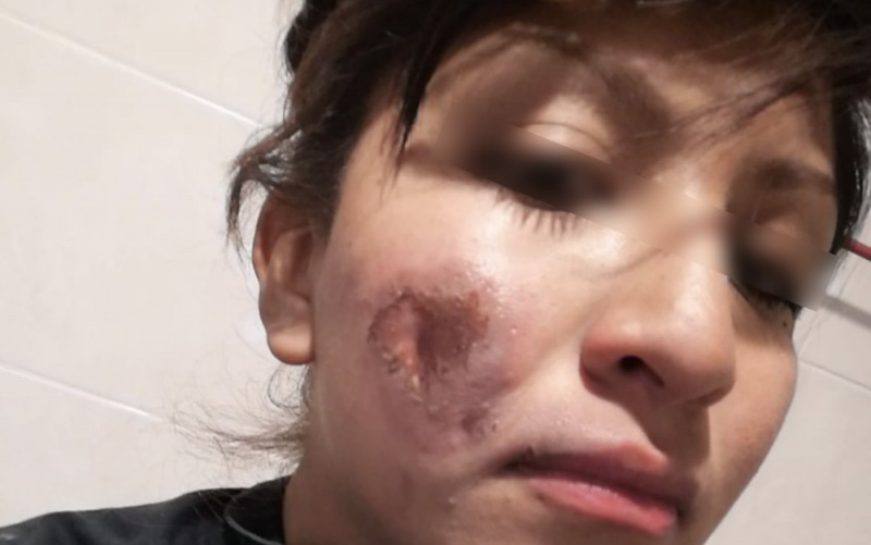 "Detrás del uniforme también hay mujeres", Policía lamenta que encapuchadas la hayan quemado