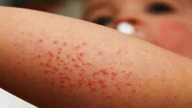 Sube a 81 el número de casos de sarampión, 77 en la CDMX