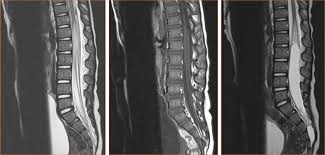 ¿Qué es la mielitis transversa que se detectó en el voluntario de AstraZeneca?
