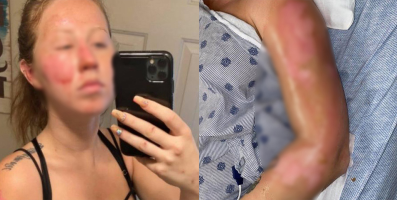 Queman rostro de chica con bebida flamante en un bar en Cancún