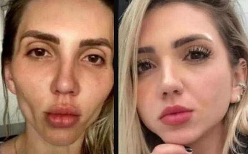 "Mi cara se cayó": influencer se arrepiente de hacerse la bichectomía; caso viral