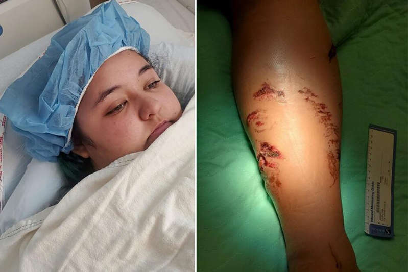 Atacan a joven estadounidense por un cocodrilo en playas mexicanas