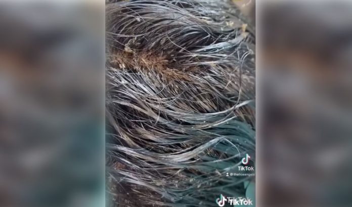 Cabeza de niña infestada con más de 15 mil piojos aterroriza TikTok