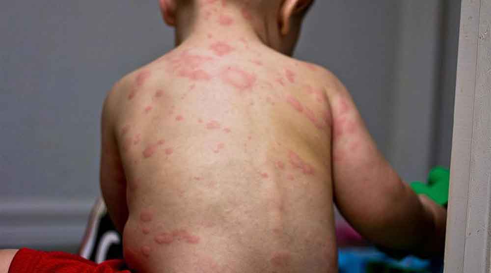 Alerta ONU por aumento de casos de sarampión en el mundo