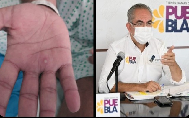 Secretaría de Salud reporta tres nuevos casos sospechosos de la viruela símica en Puebla