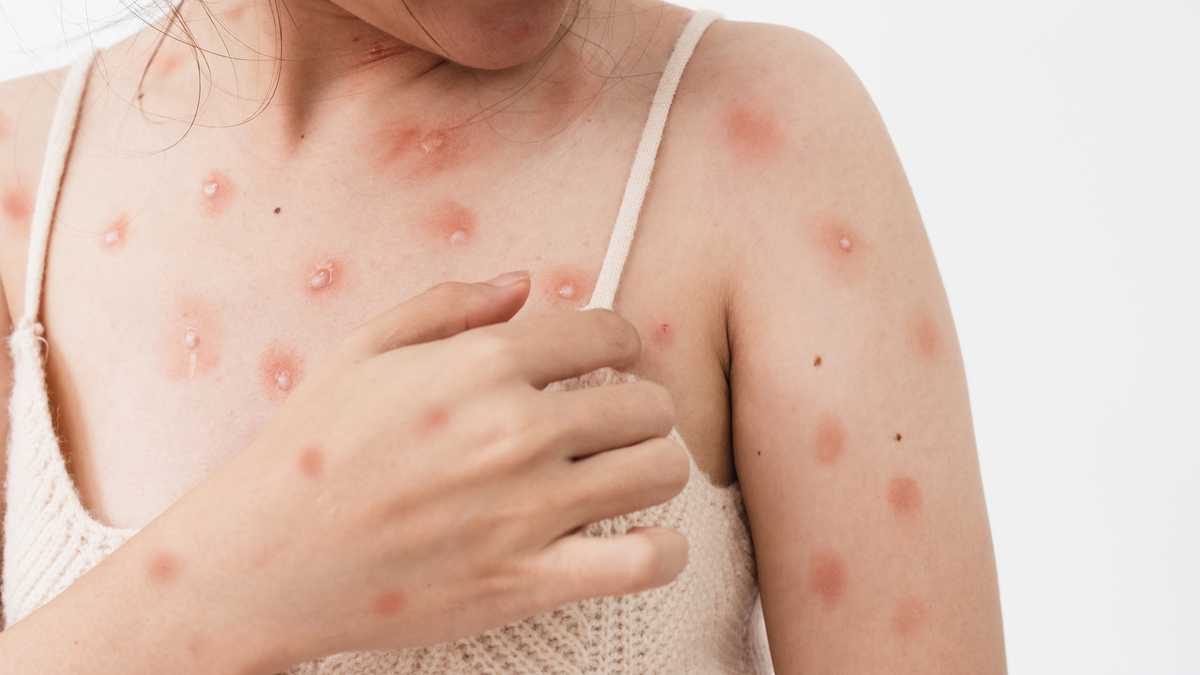 Ayuntamiento de Puebla sumará esfuerzos con el gobierno del estado para prevenir contagios de viruela del mono