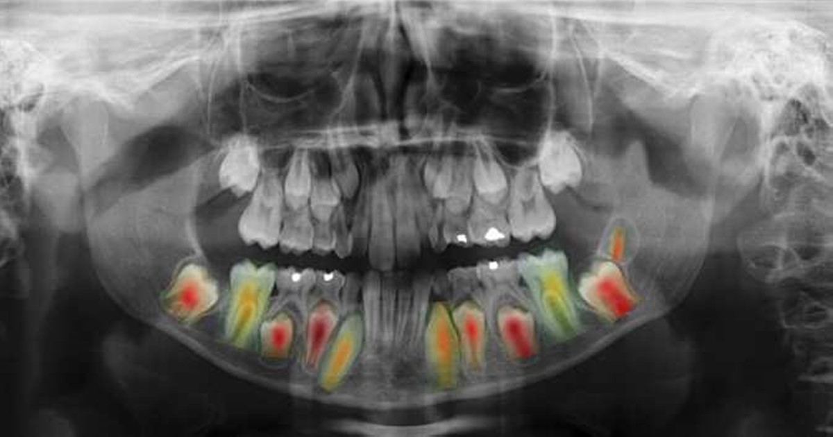 Cálculo automático de edad y sexo de una persona a partir de radiografías dentales