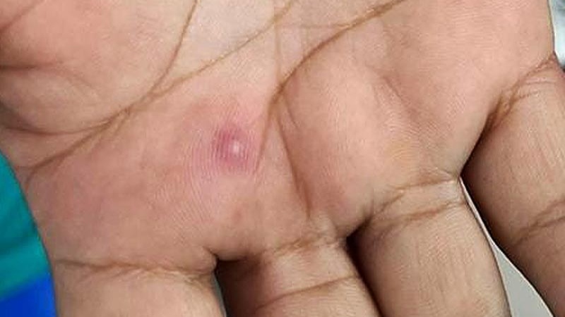 Investiga Jalisco su primera muerte asociada a viruela del mono