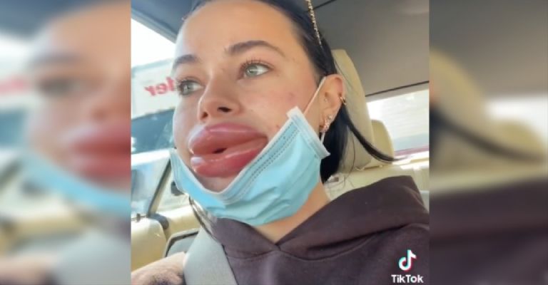 Mujer queda desfigurada tras someterse a tratamiento  con ácido hialurónico (Vídeo)