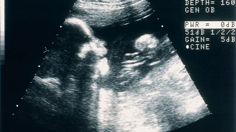 Operan el cerebro de un feto por primera vez en la historia 