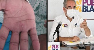 Secretaría de Salud reporta tres nuevos casos sospechosos de la viruela símica en Puebla
