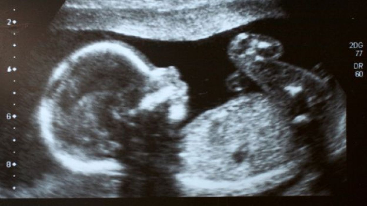 Bebé nace 'embarazada' de su hermano gemelo