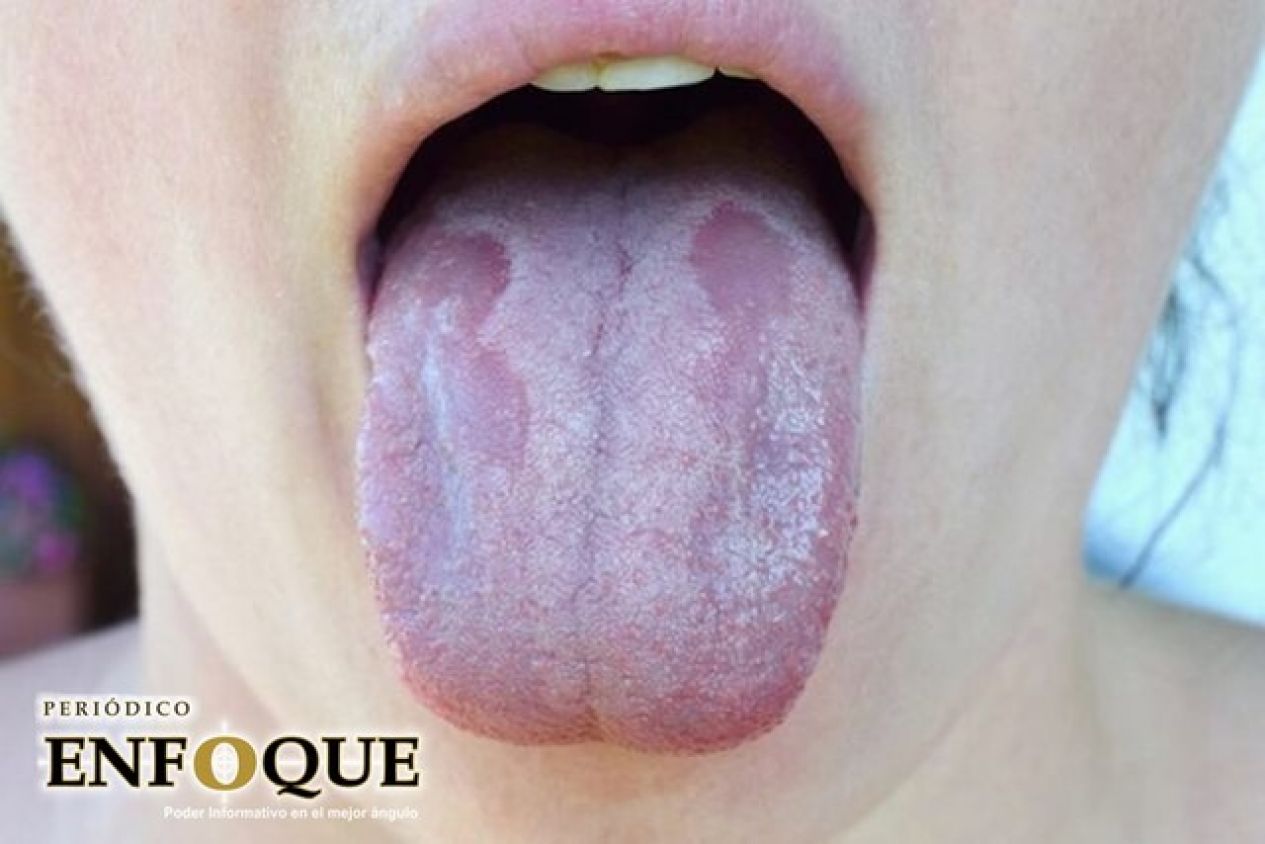 Lengua Covid: El nuevo síntoma que podría alertar de una infección de coronavirus 