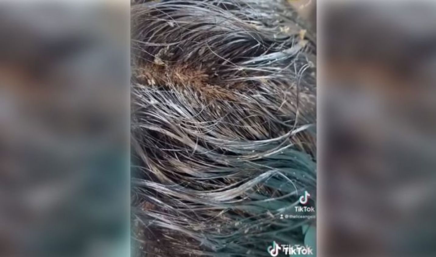 Cabeza de niña infestada con más de 15 mil piojos aterroriza TikTok