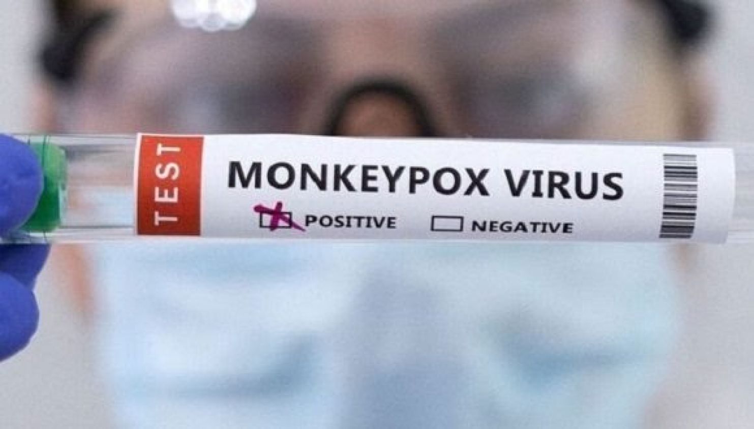 Confirma Cuba su primer caso de viruela del mono