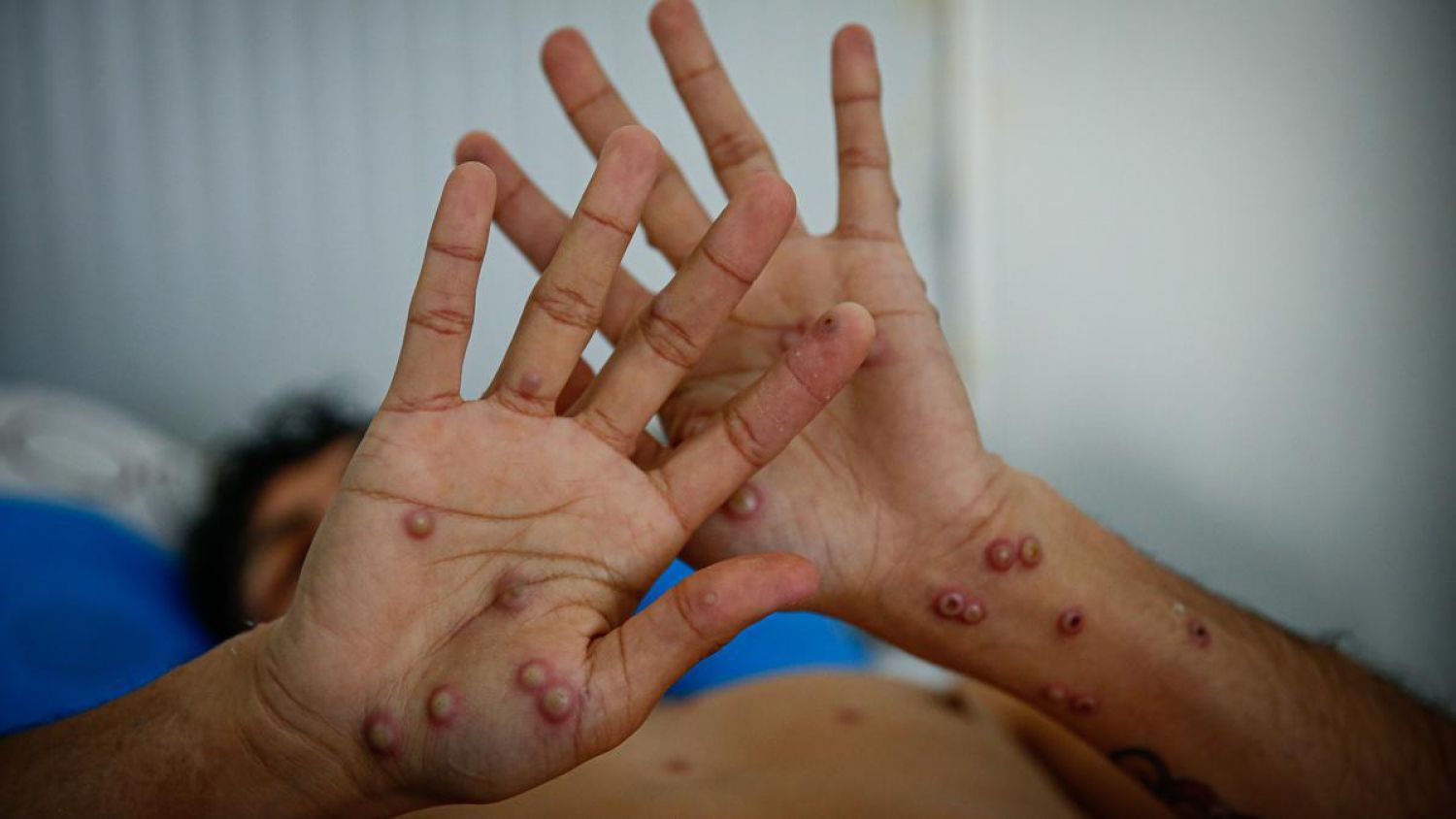Confirma Chiapas 4 casos más de viruela símica, hasta ahora se han acumulado 14 contagios