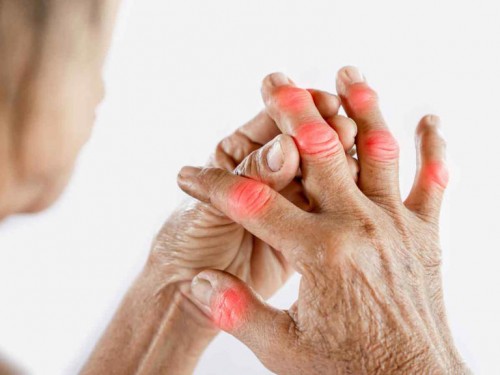 ¿Dolor en las articulaciones? Estas enfermedades podrían estar detrás de las molestias