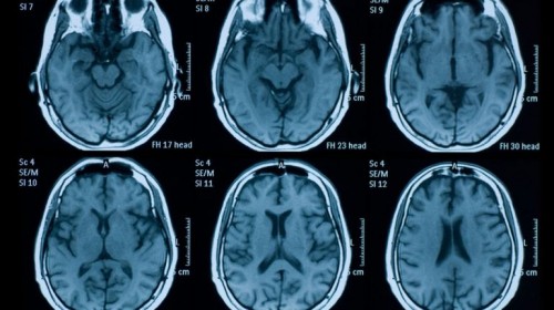 Confirman que la adicción a la cocaína provoca envejecimiento en el cerebro 